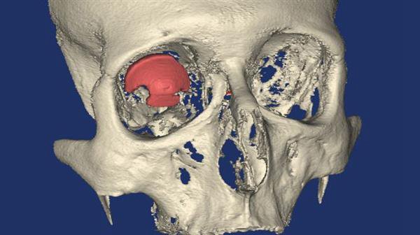 3D打印技術(shù)在醫(yī)療方面的應(yīng)用 世界首個(gè)3D打印義眼_E鍵3D打印服務(wù) 3D打印技術(shù)在醫(yī)療方面的應(yīng)用 世界首個(gè)3D打印義眼_E鍵3D打印服務(wù)
