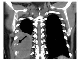 第四軍醫大學精彩分享個性化醫療3D打印的實戰案例與研究成果 第四軍醫大學精彩分享個性化醫療3D打印的實戰案例與研究成果