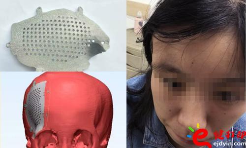 醫療3d打印應用,醫用3d打印,3D打印假肢,3D打印脊椎,3D打印心臟,e鍵打印,3d打印服務 3D打印的顱骨假體，非常適用于發際外的顱骨缺損、病變置換，將使患者的面容恢復到正常形態，完美解決了傳統顱骨修補存在的美容問題。據悉，3D打印個性化顱骨假體修補技術已獲國家重點研發計劃資助，能為一批病人免費提供假體，并能減免一些檢查和治療費用。未來將實行72小時的3D假體個性化顱骨修補術，造福更多的患者。