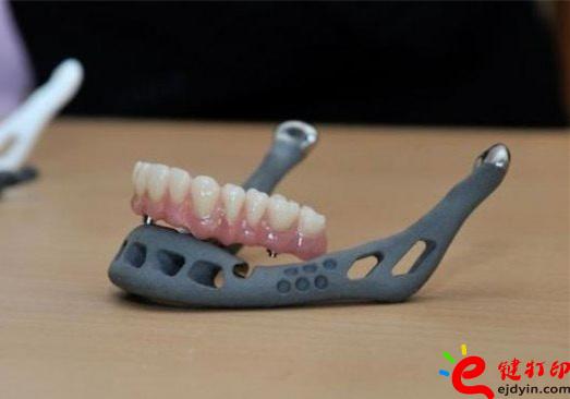 3D打印牙嵌體和牙套哪種更好？3D打印牙齒/隱形牙套/牙冠/模型/成品價格表