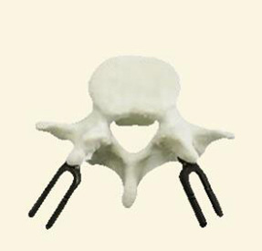 腰椎金屬植入物4