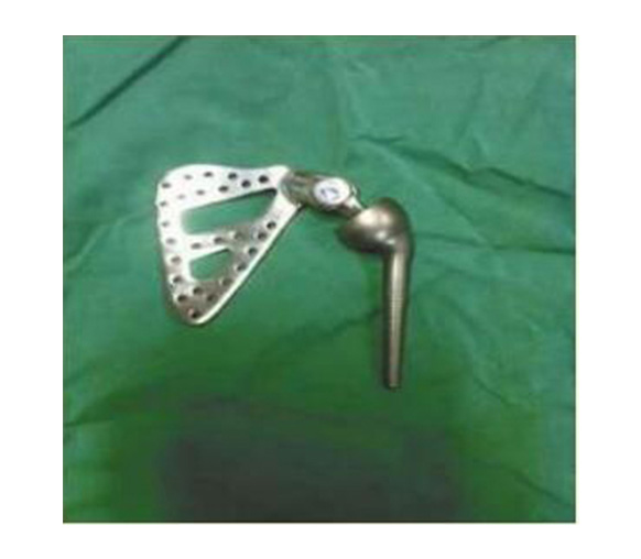 肩關節金屬植入物1